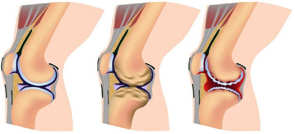 Healthy joints and affected by arthritis