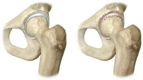 Hip joints are healthy and are affected by joint disease